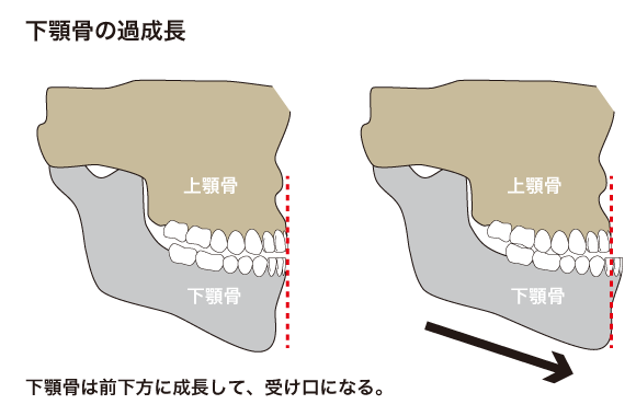 子どもの矯正治療 矯正歯科 歯医者 名古屋から急行で10分 なら ひらざわ矯正歯科クリニック